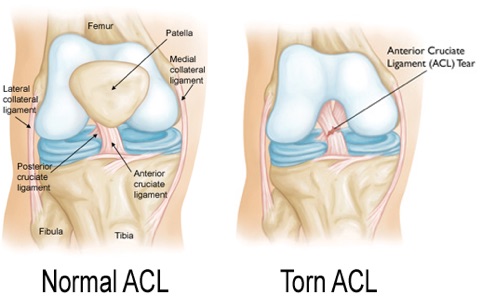 torn acl recovery time