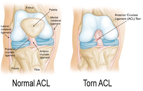 Accelerate Full Recovery from ACL Injuries with Cryotherapy